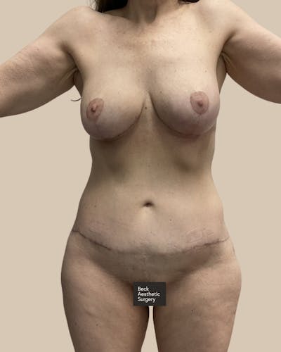 Liposuction Before & After Gallery - Patient 201977 - Image 2