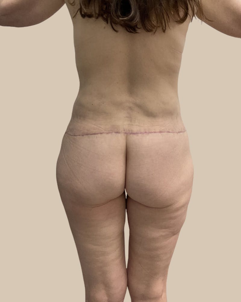 Mommy Makeover Before & After Gallery - Patient 230555 - Image 4