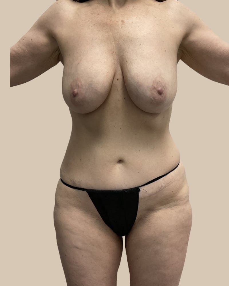 Mommy Makeover Before & After Gallery - Patient 230555 - Image 1