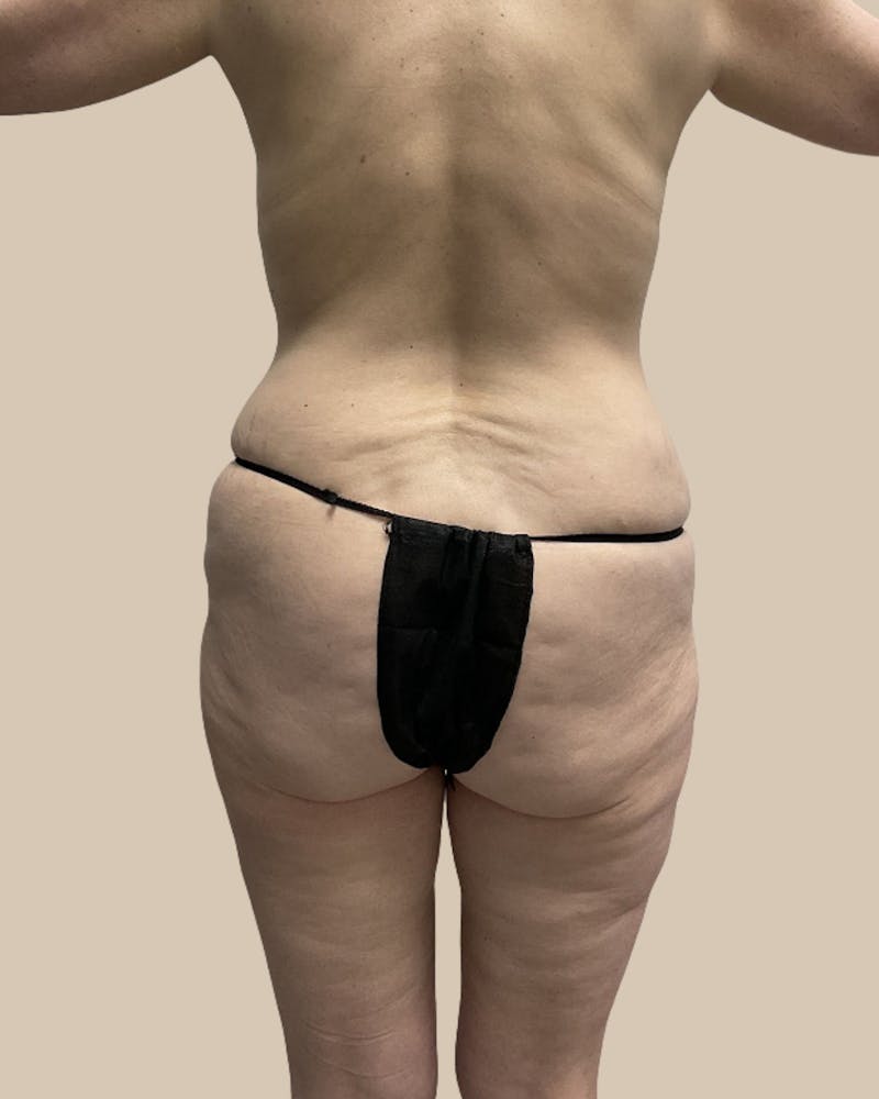 Mommy Makeover Before & After Gallery - Patient 230555 - Image 3