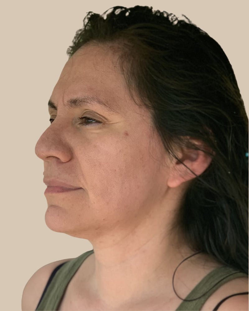 Microneedling Before & After Gallery - Patient 718717 - Image 3