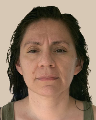 Microneedling Before & After Gallery - Patient 718717 - Image 1