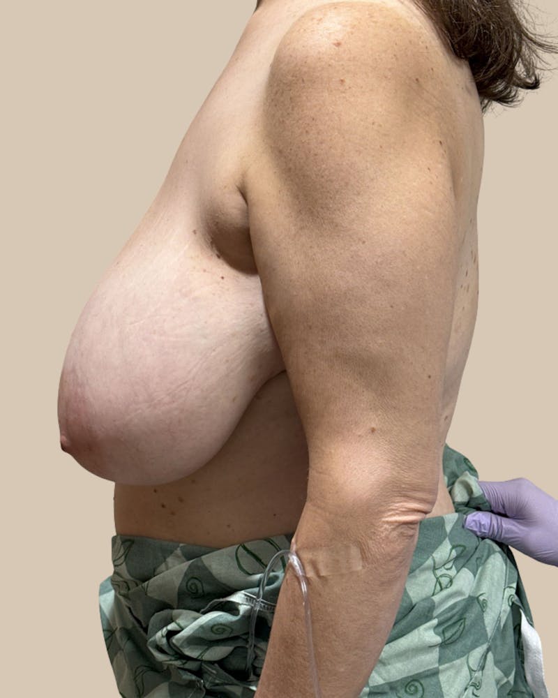 Breast Reduction Before & After Gallery - Patient 196741 - Image 1
