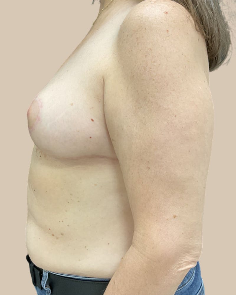 Breast Reduction Before & After Gallery - Patient 196741 - Image 2