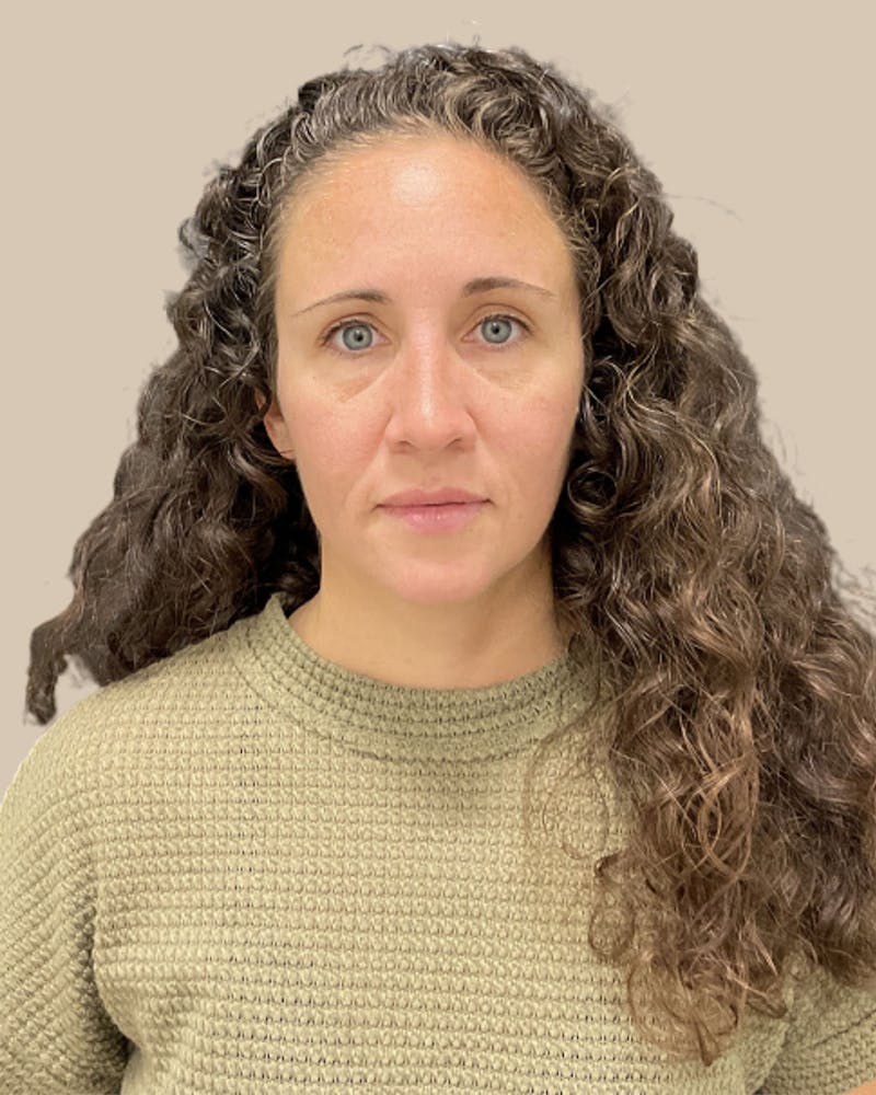 Injectables Before & After Gallery - Patient 411115 - Image 2