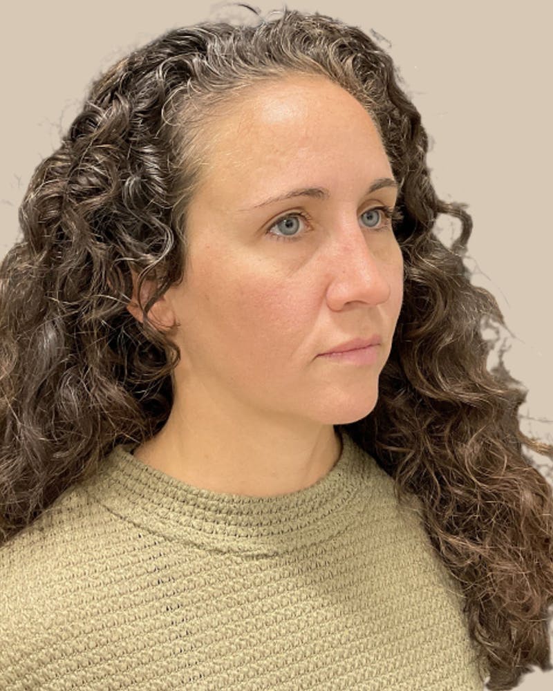 Injectables Before & After Gallery - Patient 411115 - Image 4