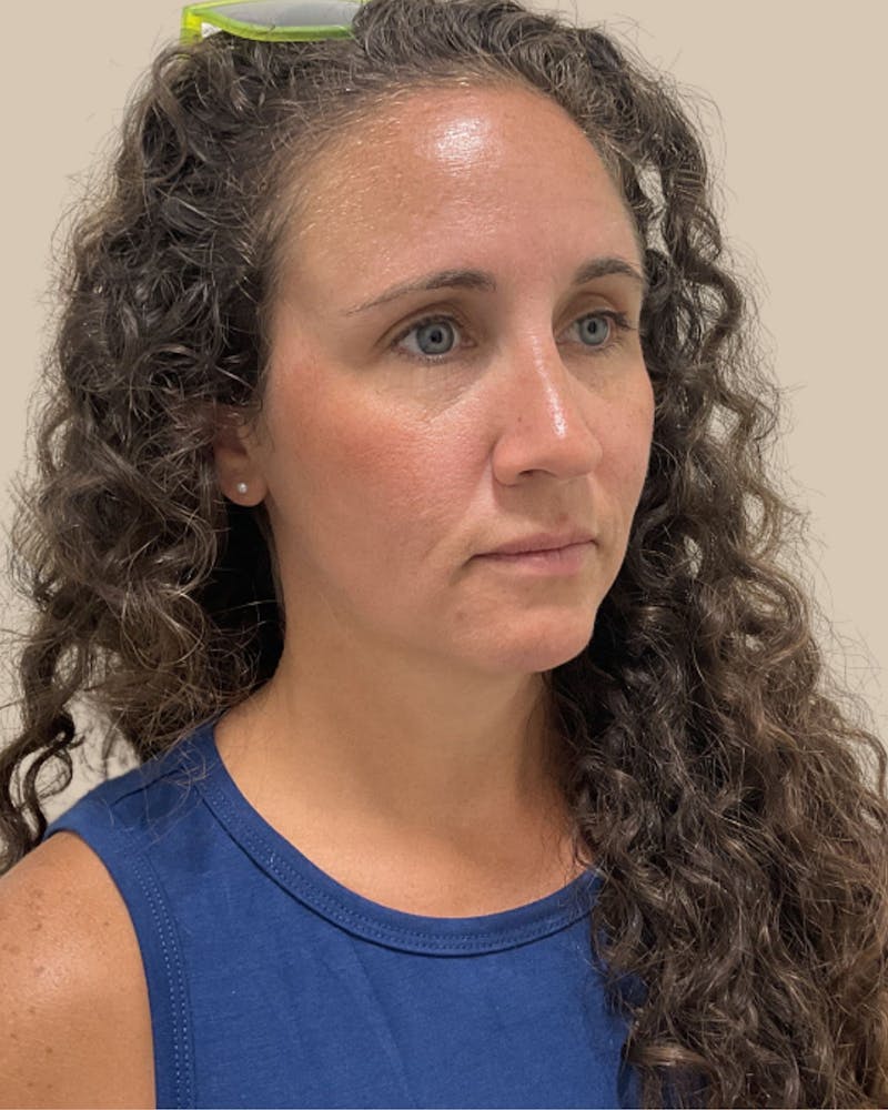 Injectables Before & After Gallery - Patient 411115 - Image 3