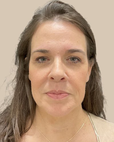 Blepharoplasty Before & After Gallery - Patient 346461 - Image 2