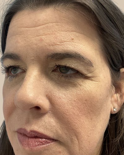 Brow Lift Before & After Gallery - Patient 336319 - Image 1