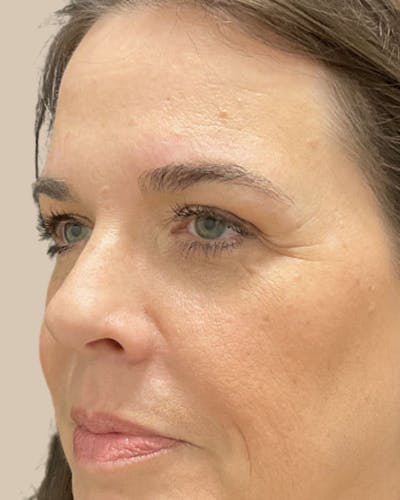 Brow Lift Before & After Gallery - Patient 336319 - Image 2