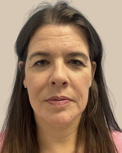 Blepharoplasty Before & After Gallery - Patient 346461 - Image 1