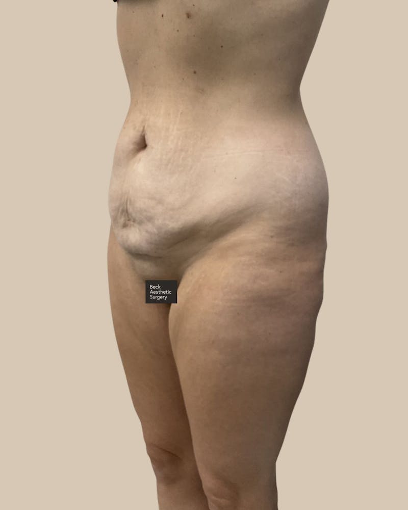 Trunkplasty Before & After Gallery - Patient 370439 - Image 3