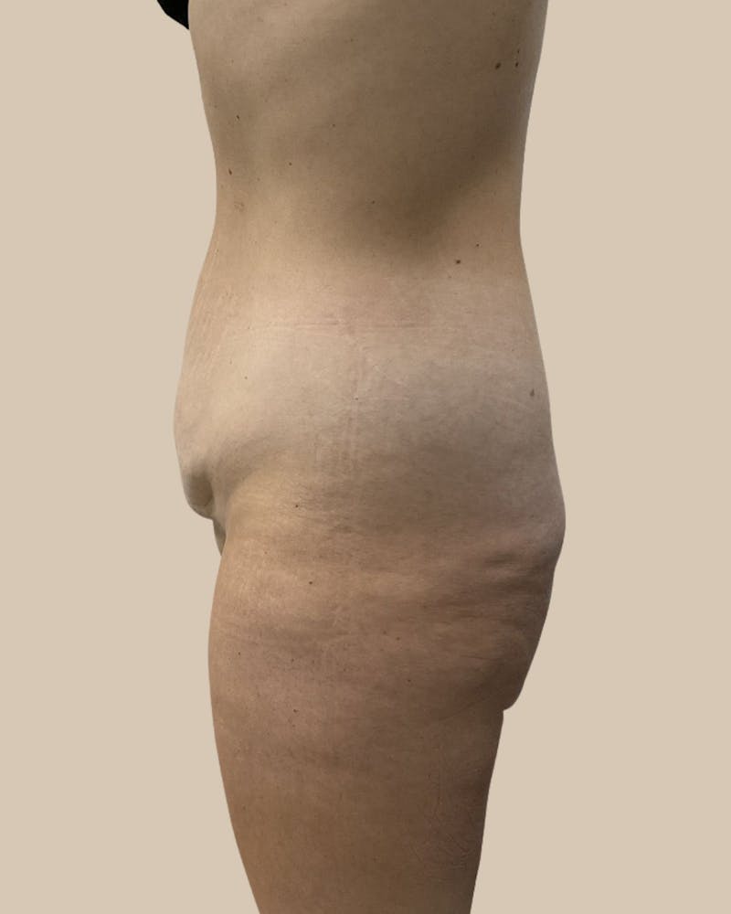 Trunkplasty Before & After Gallery - Patient 370439 - Image 5