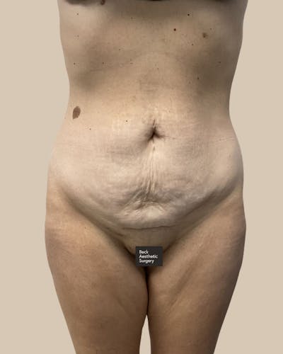 Trunkplasty Before & After Gallery - Patient 370439 - Image 1