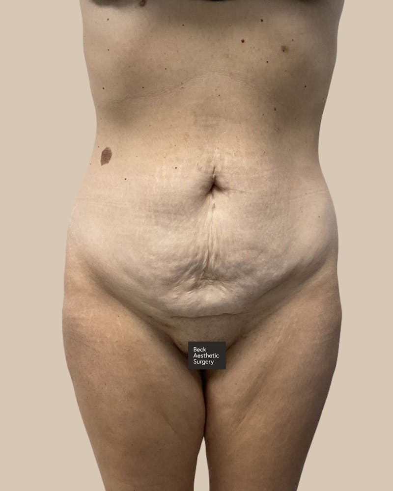 Trunkplasty Before & After Gallery - Patient 370439 - Image 1