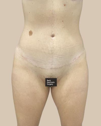 Trunkplasty Before & After Gallery - Patient 370439 - Image 2