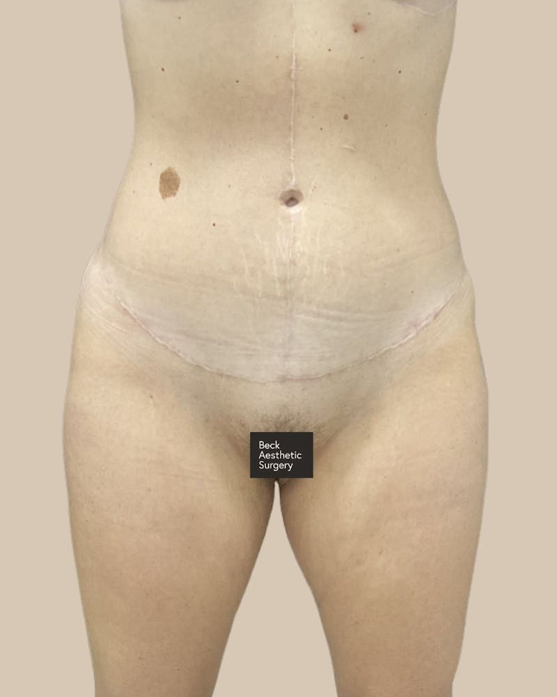 Trunkplasty Before & After Gallery - Patient 370439 - Image 2