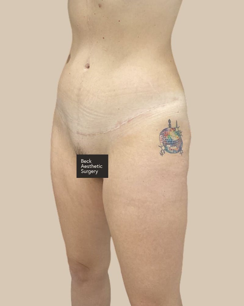 Trunkplasty Before & After Gallery - Patient 370439 - Image 4