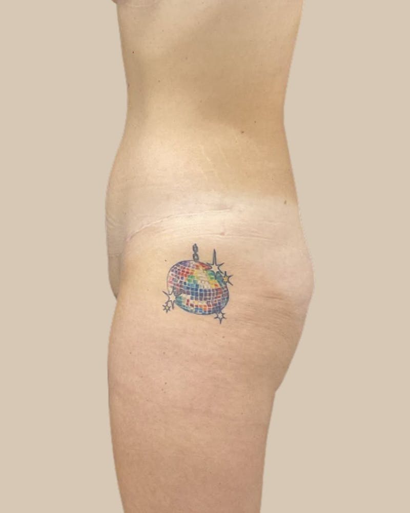 Trunkplasty Before & After Gallery - Patient 370439 - Image 6