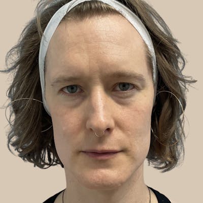 Facial Feminization Before & After Gallery - Patient 197352 - Image 1