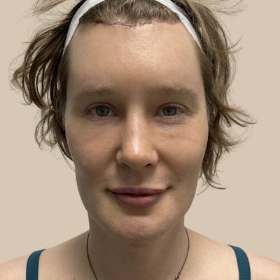 Facial Feminization Before & After Gallery - Patient 197352 - Image 2