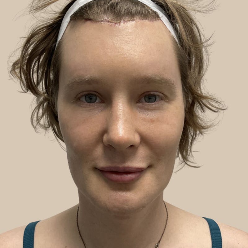 Facial Feminization Before & After Gallery - Patient 197352 - Image 2