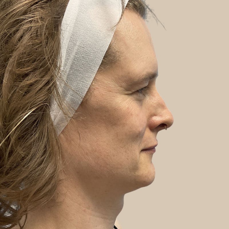 Facial Feminization Before & After Gallery - Patient 197352 - Image 3