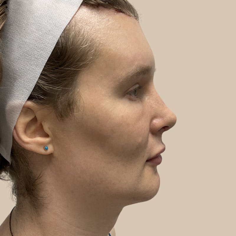 Facial Feminization Before & After Gallery - Patient 197352 - Image 4