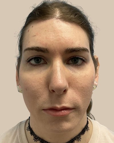 Facial Feminization Before & After Gallery - Patient 187353 - Image 2