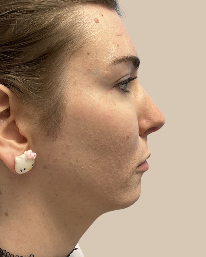 Facial Feminization Before & After Gallery - Patient 187353 - Image 4