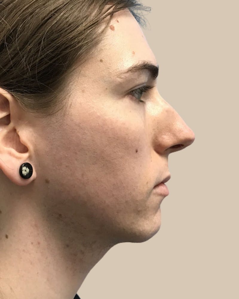 Facial Feminization Before & After Gallery - Patient 187353 - Image 3