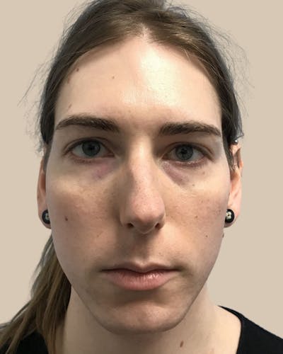 Facial Feminization Before & After Gallery - Patient 187353 - Image 1