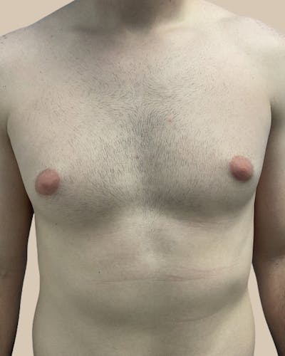 Gynecomastia Before & After Gallery - Patient 391332 - Image 1
