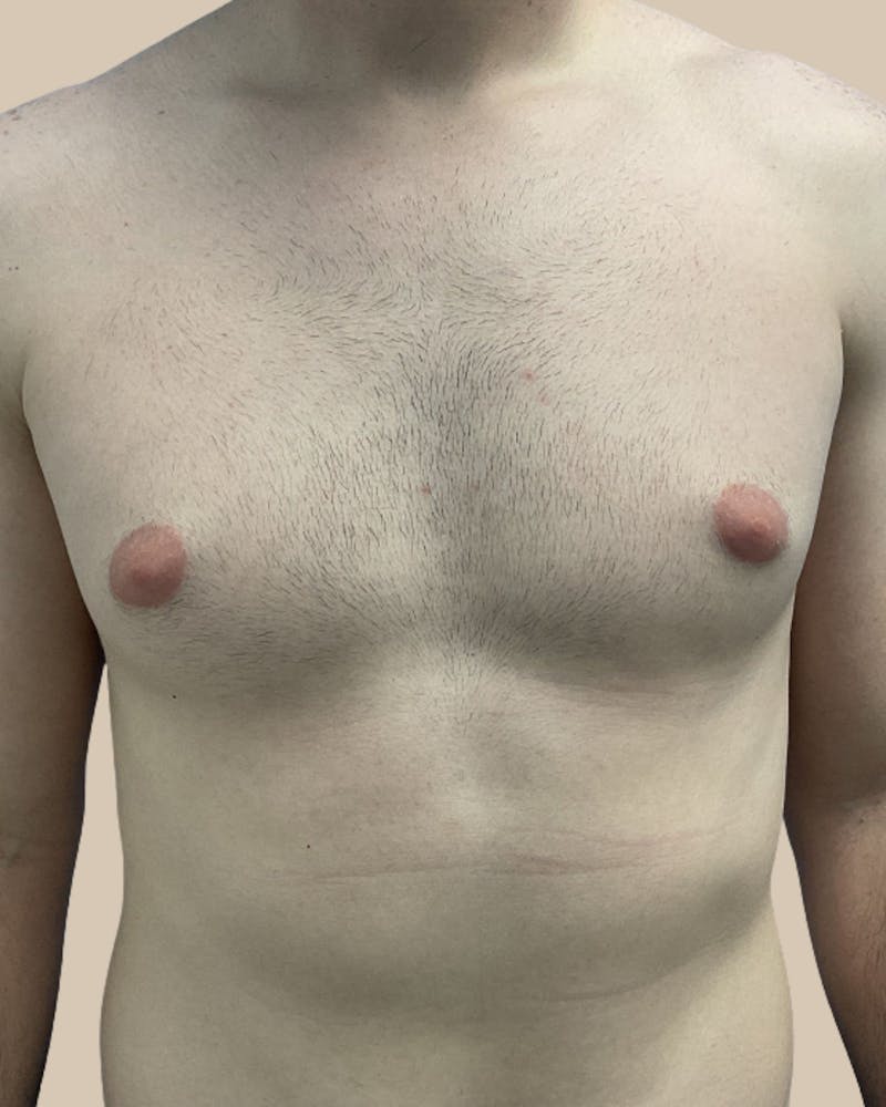 Gynecomastia Before & After Gallery - Patient 391332 - Image 1