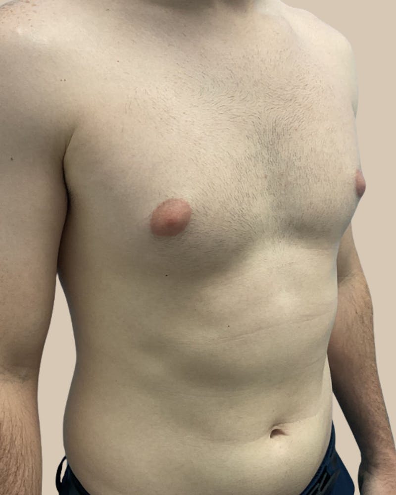 Gynecomastia Before & After Gallery - Patient 391332 - Image 3