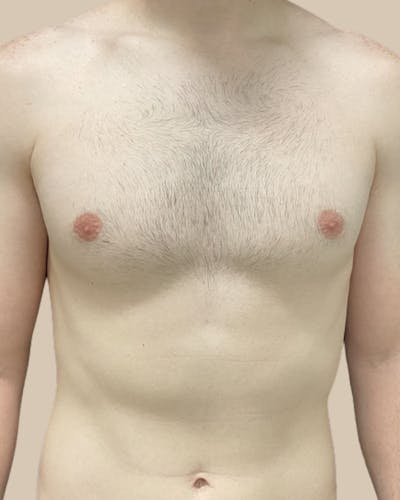 Gynecomastia Before & After Gallery - Patient 391332 - Image 2