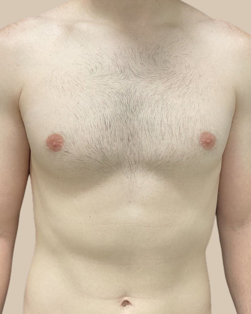 Gynecomastia Before & After Gallery - Patient 391332 - Image 2