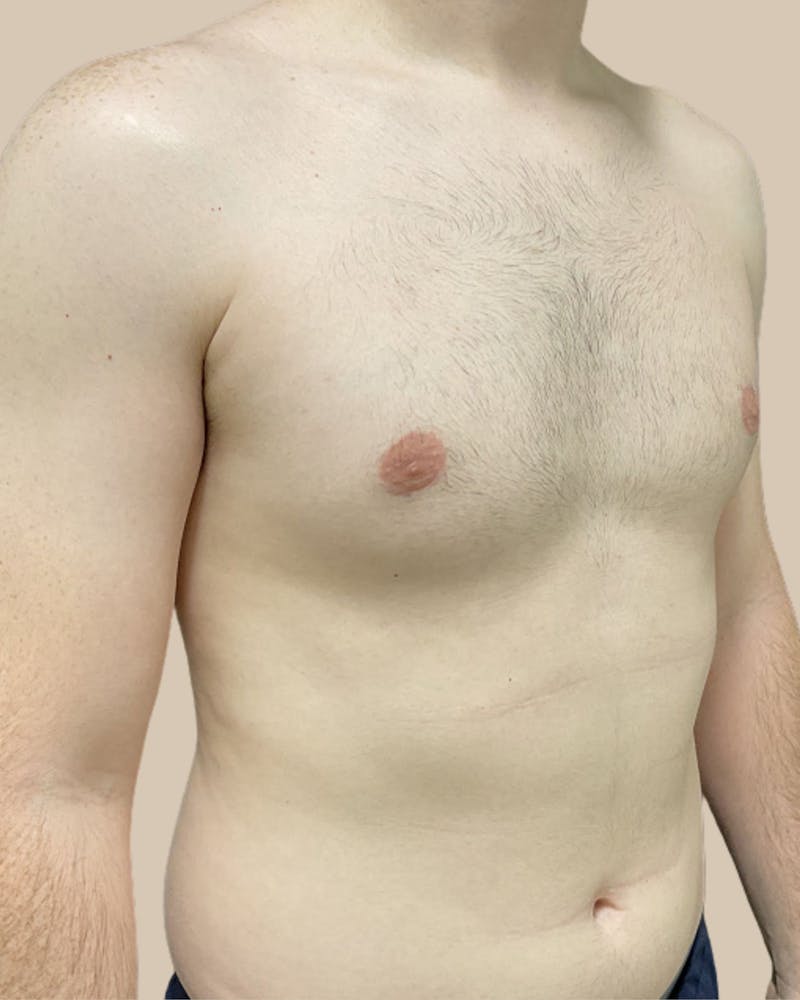 Gynecomastia Before & After Gallery - Patient 391332 - Image 4