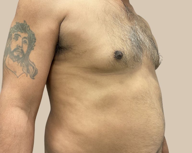 Gynecomastia Before & After Gallery - Patient 189285 - Image 4