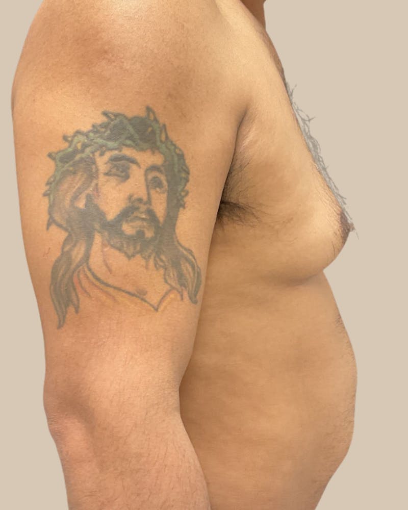 Gynecomastia Before & After Gallery - Patient 189285 - Image 5