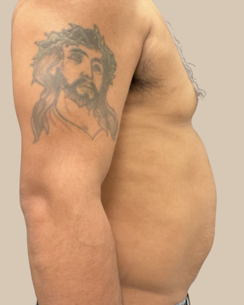 Gynecomastia Before & After Gallery - Patient 189285 - Image 6
