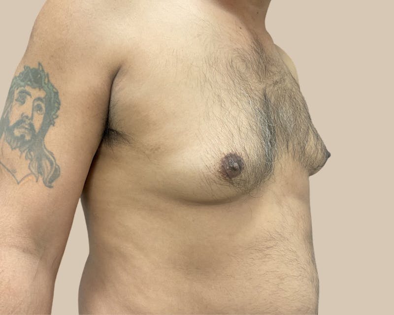 Gynecomastia Before & After Gallery - Patient 189285 - Image 3