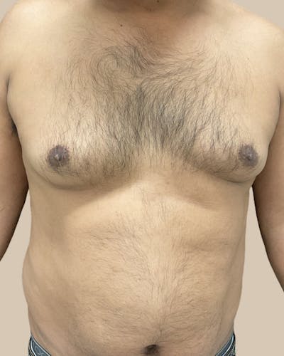 Gynecomastia Before & After Gallery - Patient 189285 - Image 1