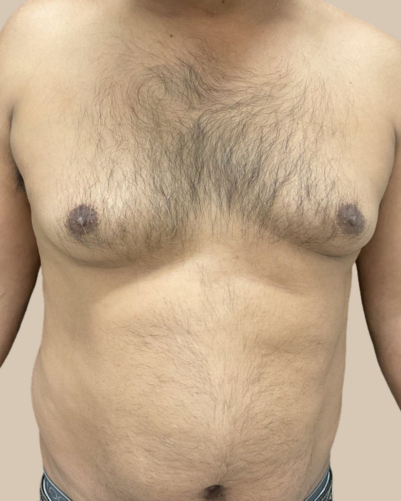 Gynecomastia Before & After Gallery - Patient 189285 - Image 1