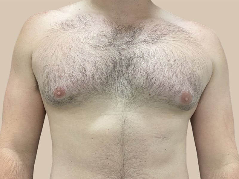 Gynecomastia Before & After Gallery - Patient 267627 - Image 1