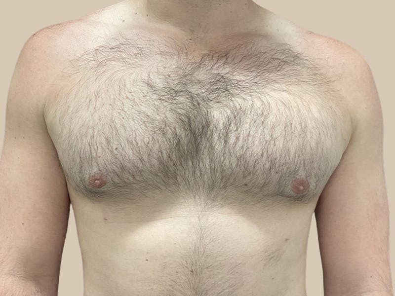 Gynecomastia Before & After Gallery - Patient 267627 - Image 2