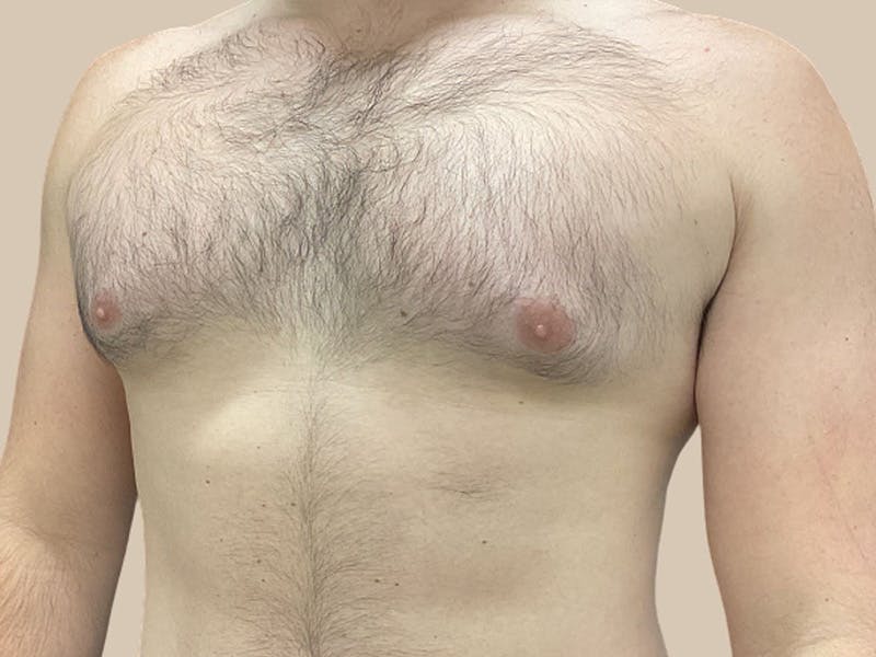 Gynecomastia Before & After Gallery - Patient 267627 - Image 3