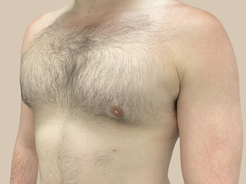 Gynecomastia Before & After Gallery - Patient 267627 - Image 4