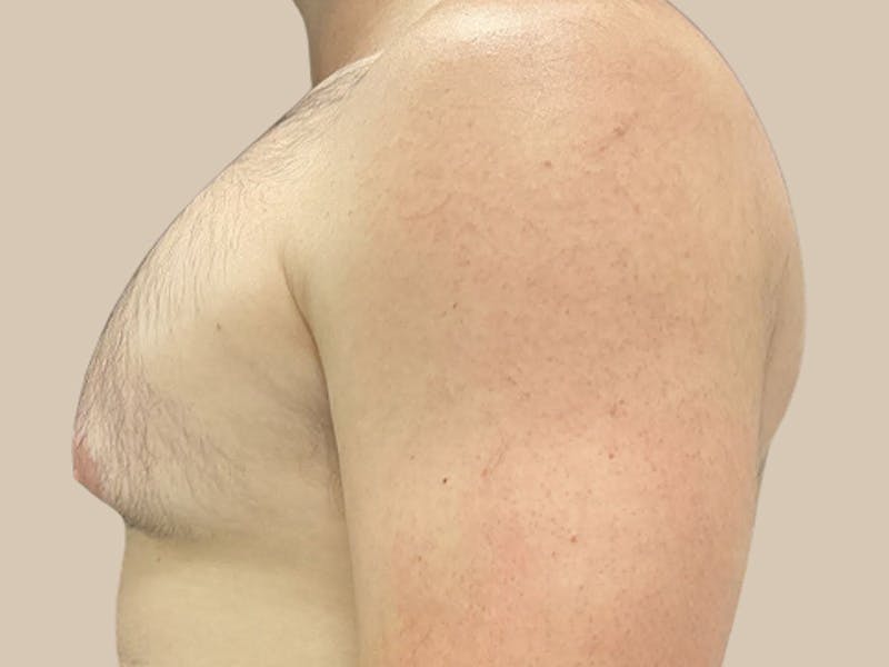 Gynecomastia Before & After Gallery - Patient 267627 - Image 5