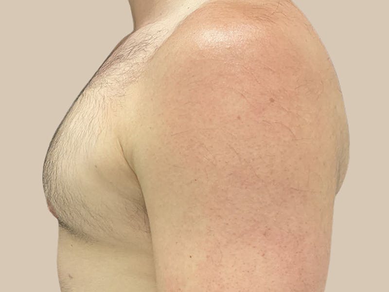Gynecomastia Before & After Gallery - Patient 267627 - Image 6